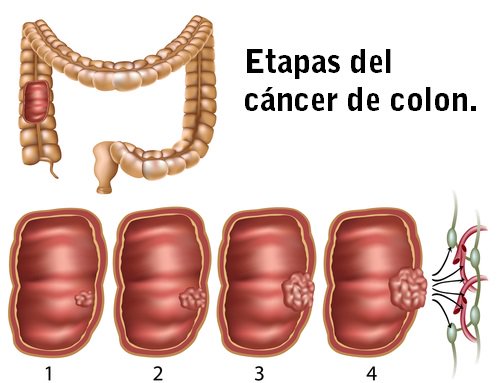 Cancer-de-colon